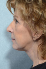Facelift
