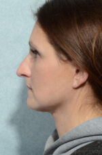 Facelift