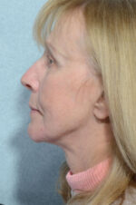 Facelift