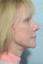 Facelift