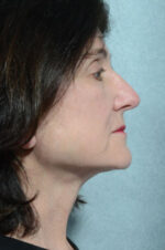 Facelift