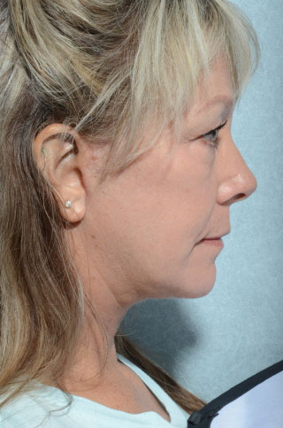 Facelift