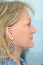 Facelift