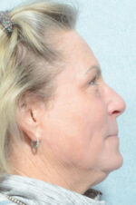 Facelift