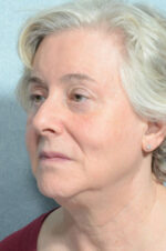 Facelift