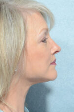 Facelift