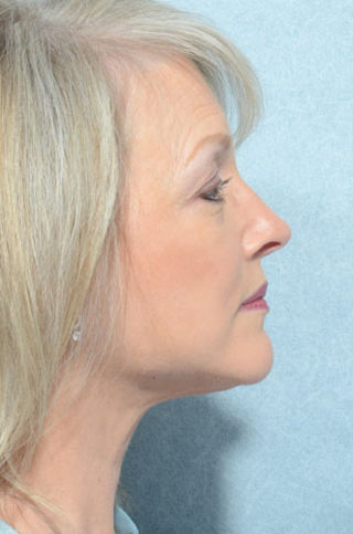 Facelift