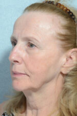 Facelift