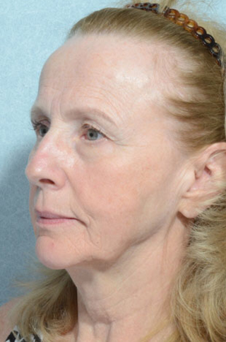 Facelift