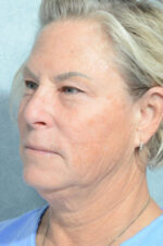 Facelift