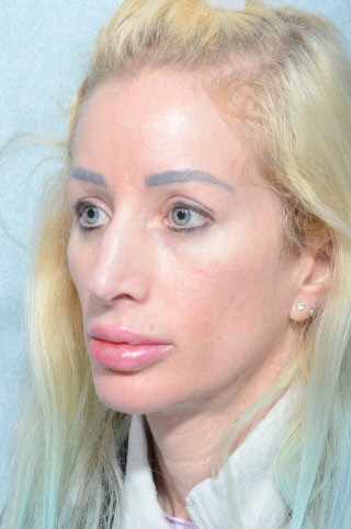 Facelift