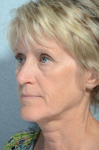 Facelift