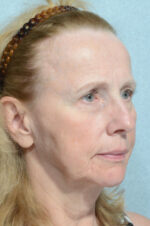 Facelift