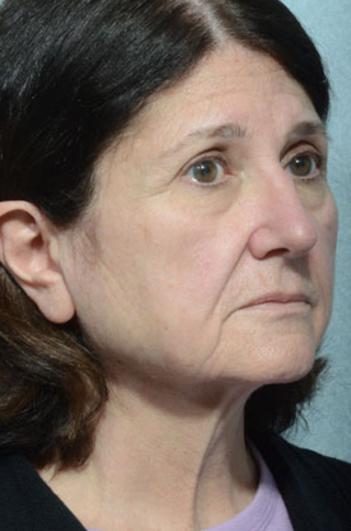 Facelift