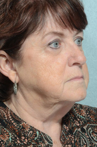 Facelift