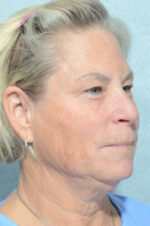 Facelift