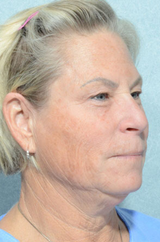 Facelift