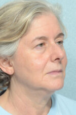 Facelift
