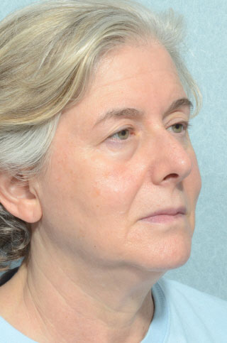 Facelift