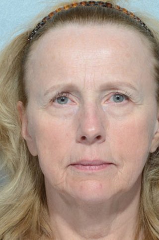 Facelift