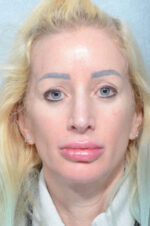 Facelift