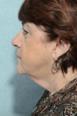 Facelift