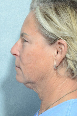 Facelift