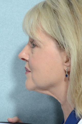 Facelift