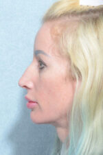 Facelift