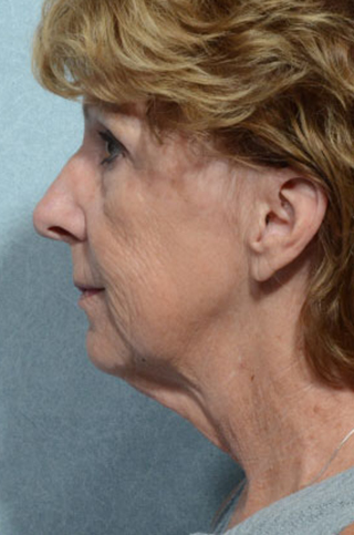 Facelift