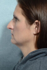 Facelift