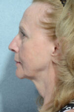Facelift