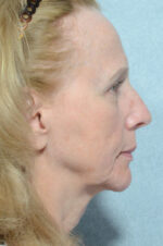 Facelift