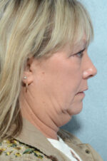 Facelift