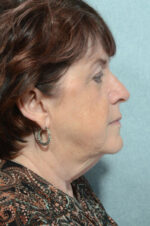 Facelift