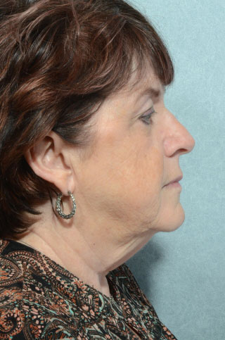 Facelift