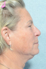Facelift