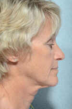 Facelift
