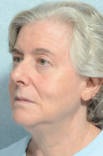 Facelift