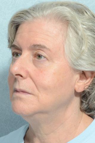 Facelift