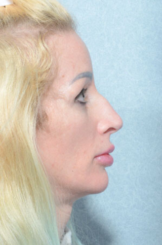 Facelift