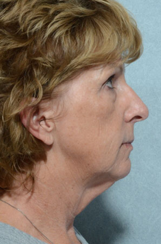 Facelift