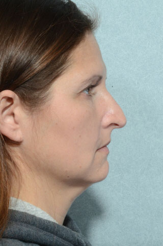 Facelift