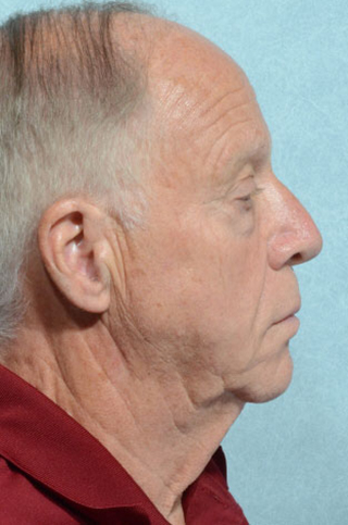 Facelift