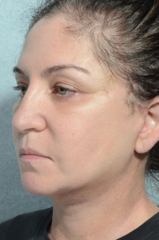 Facelift
