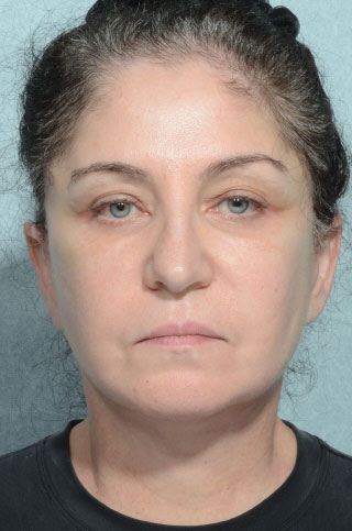 Facelift