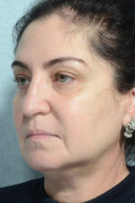 Facelift