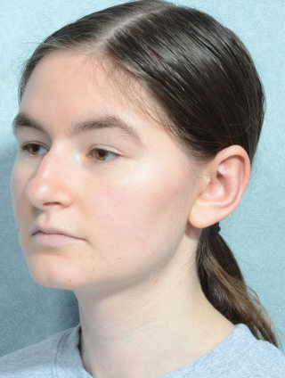 Otoplasty