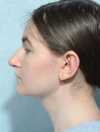 Otoplasty