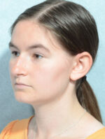 Otoplasty